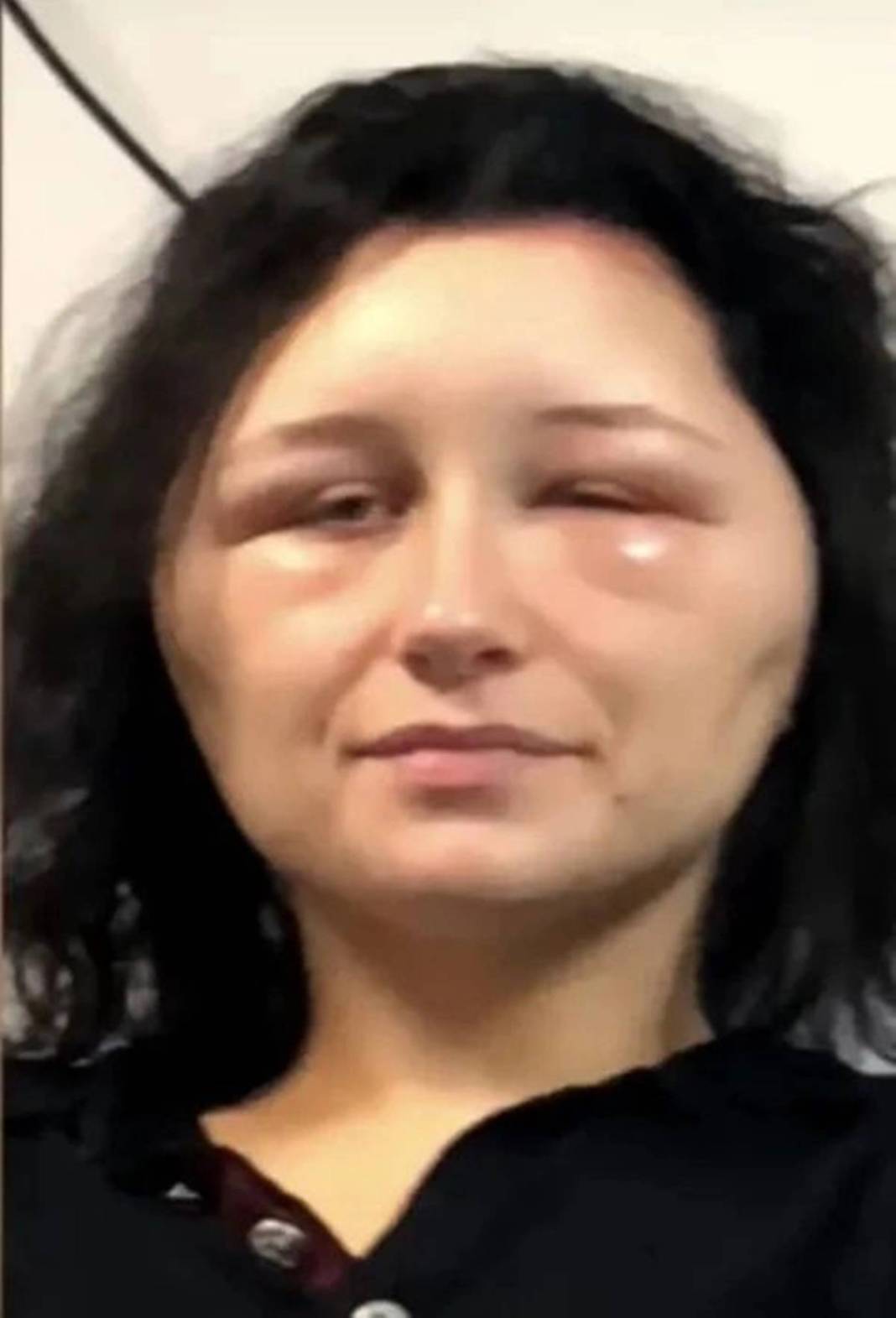 Marketten aldığı ürünle saçını boyadı: Kafası ampul gibi şişti! Yakınları bile tanıyamadı 3